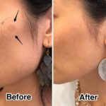Laser Treatment: What to Expect – Side Effects Unveiled